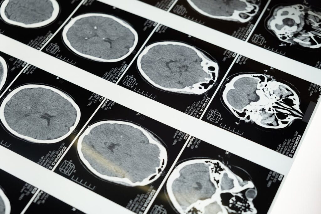 qué es el brainrot